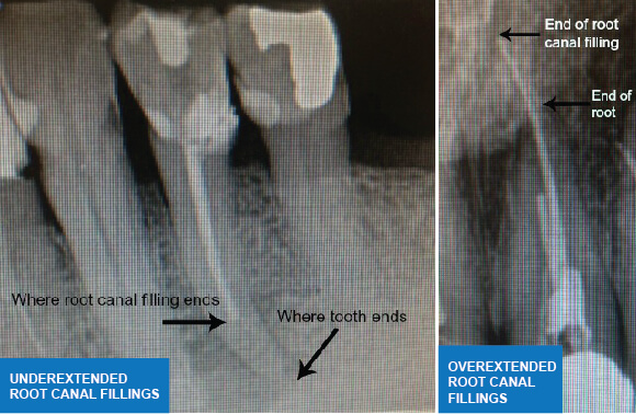 Root Canal Treatment - Fillings