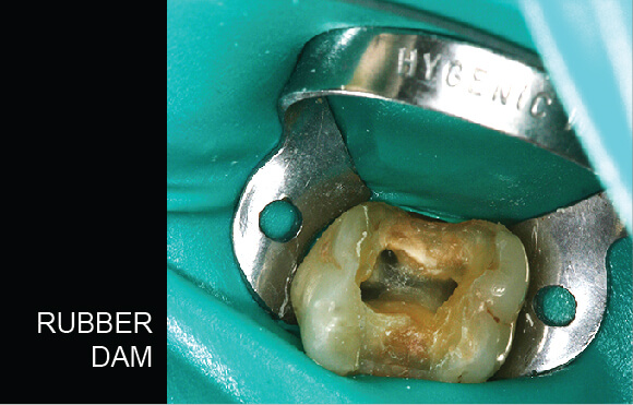 Root Canal Treatment - Rubber Dam