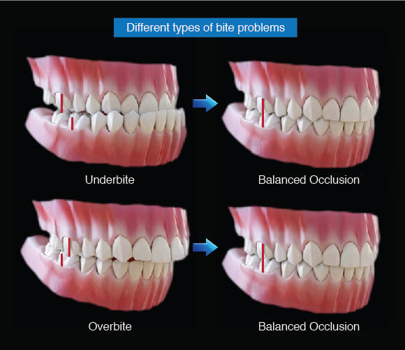 Dental Occlusion / Anterior Guidance Part 2