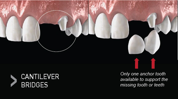Cantilever Dental Bridge Facts