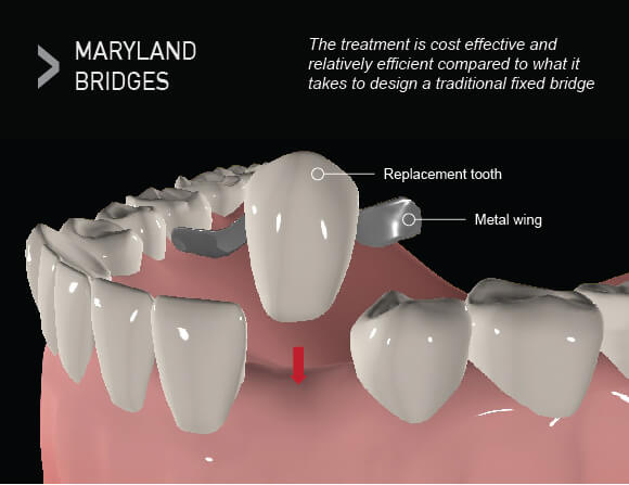 Types of Dental Bridges - Maryland - Westcoast