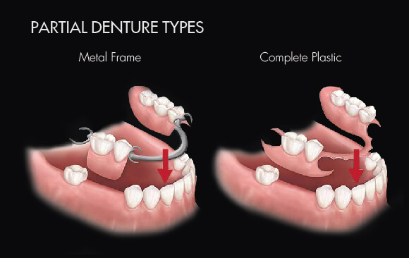 Partial Dentures Types