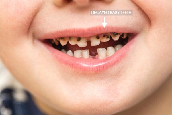 Decayed Baby Teeth