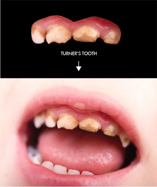 Primary Teeth - Baby Teeth