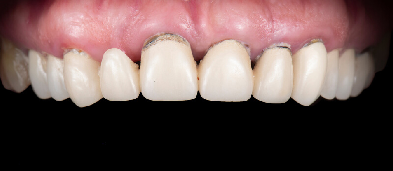Gum Disease Risk
