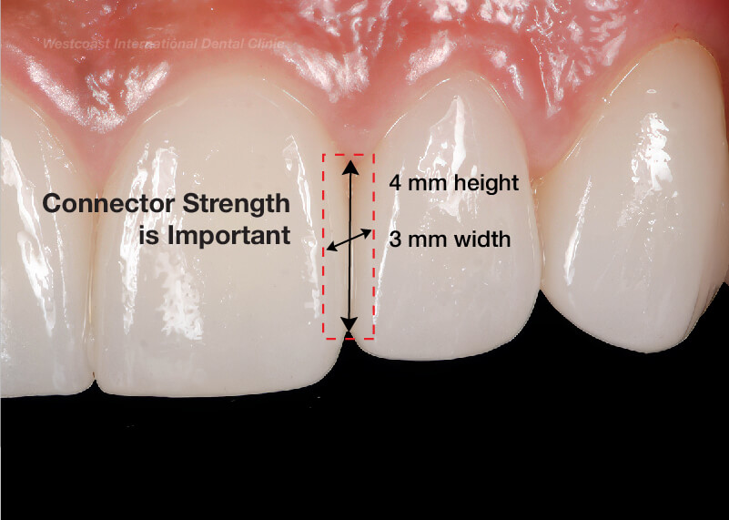 Dental Bridge Connector Strength 