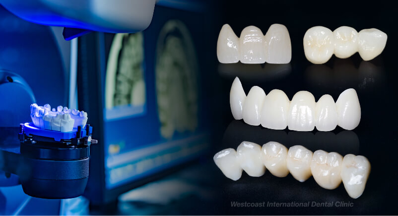 Full-milled Zirconia Dental Bridge