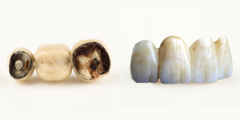 Cavities form under the bridge.