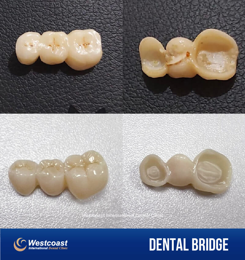 Dental Bridge Kept Falling