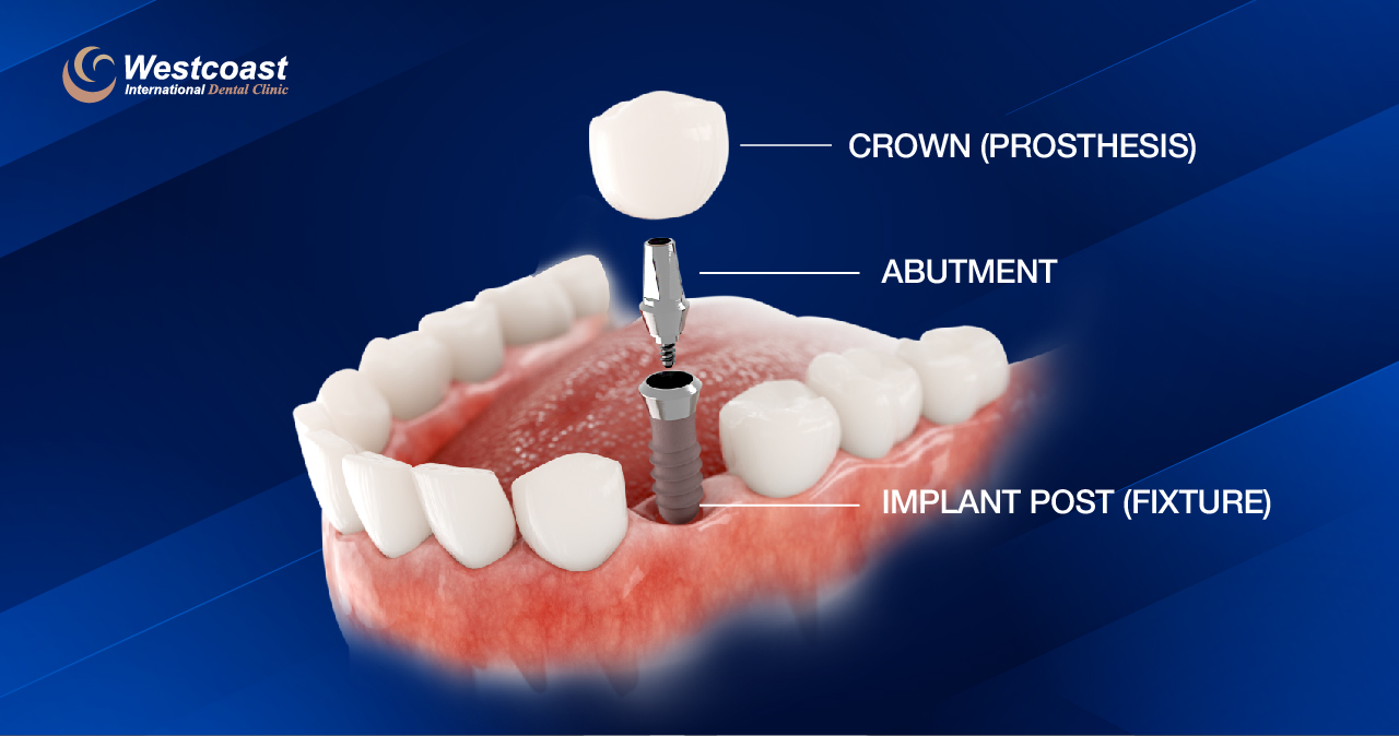 what are dental implants