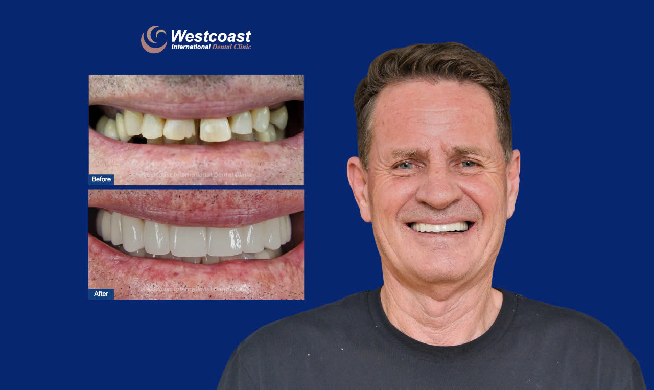 Before and after full mouth dental implants at Westcoast