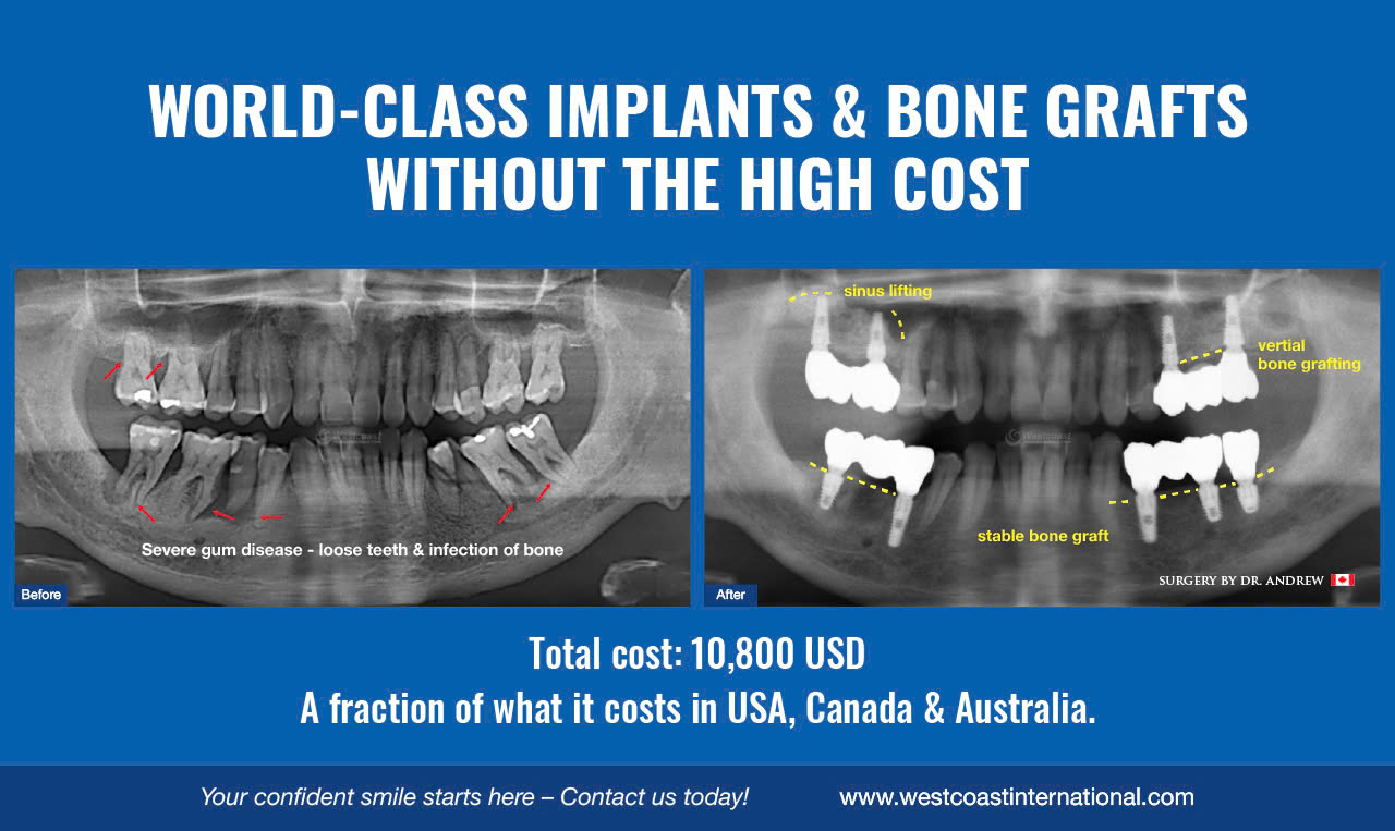Dental implant price comparison Vietnam vs USA - Canada