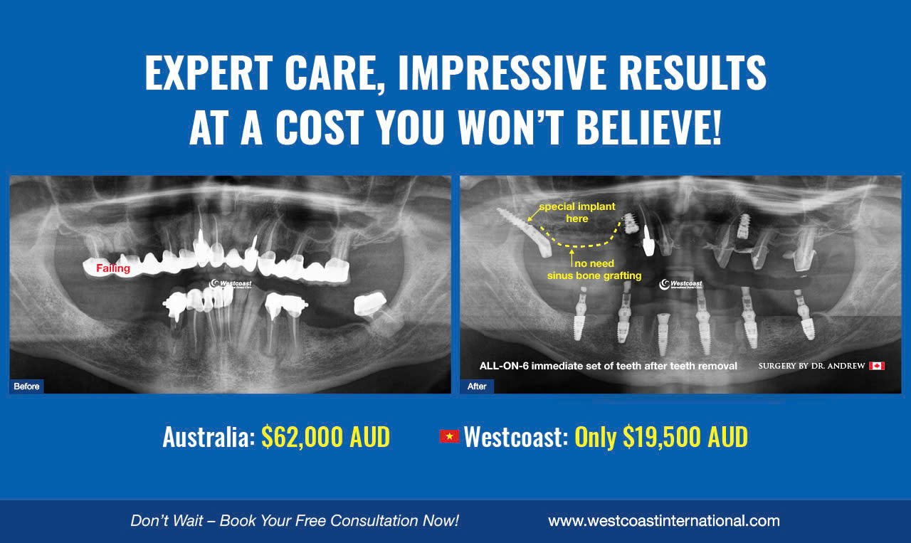 Dental implant price comparison Vietnam vs Australia