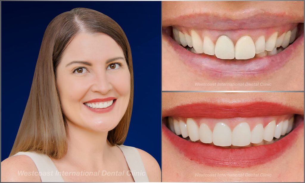 Westcoast Dental Clinic Smiles Gallery Westcoast Dental Clinic Smiles Gallery