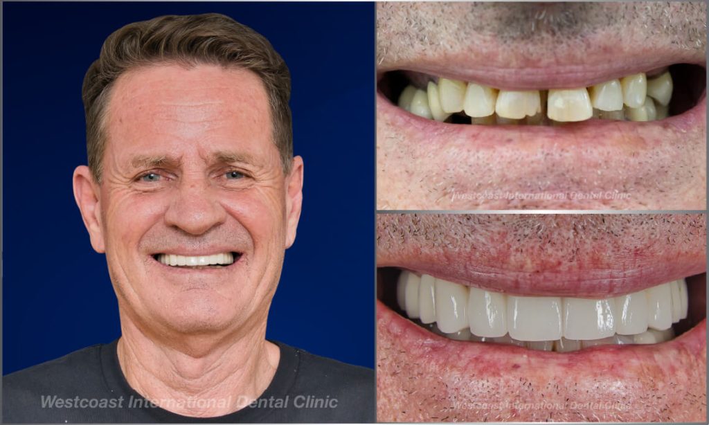 Westcoast Dental Clinic Smiles Gallery Westcoast Dental Clinic Smiles Gallery