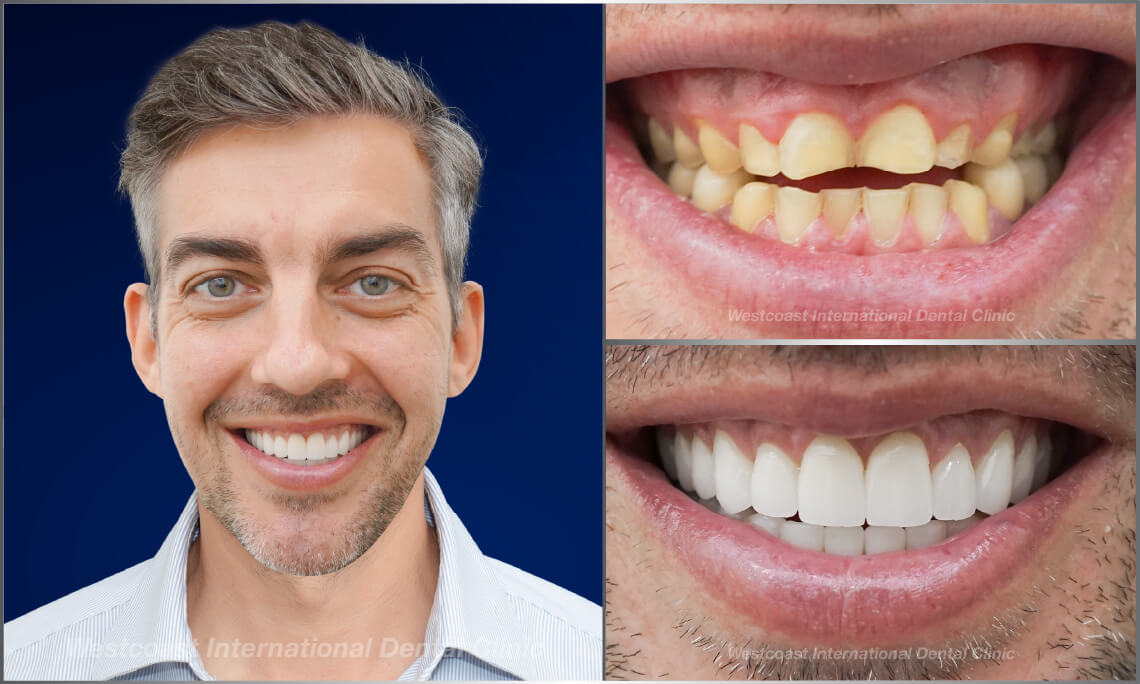 Westcoast Dental Clinic Smiles Gallery Westcoast Dental Clinic Smiles Gallery