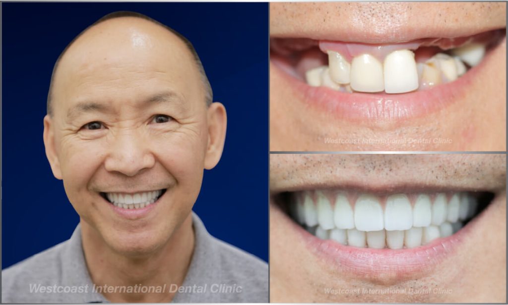 Westcoast Dental Clinic Smiles Gallery Westcoast Dental Clinic Smiles Gallery