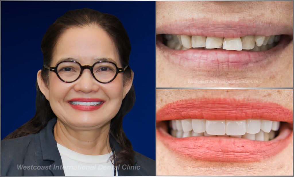 Westcoast Dental Clinic Smiles Gallery Westcoast Dental Clinic Smiles Gallery