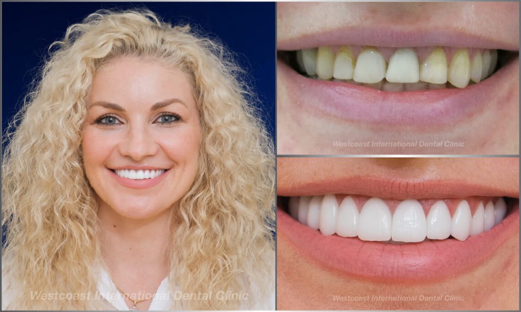 Westcoast Dental Clinic Smiles Gallery Westcoast Dental Clinic Smiles Gallery