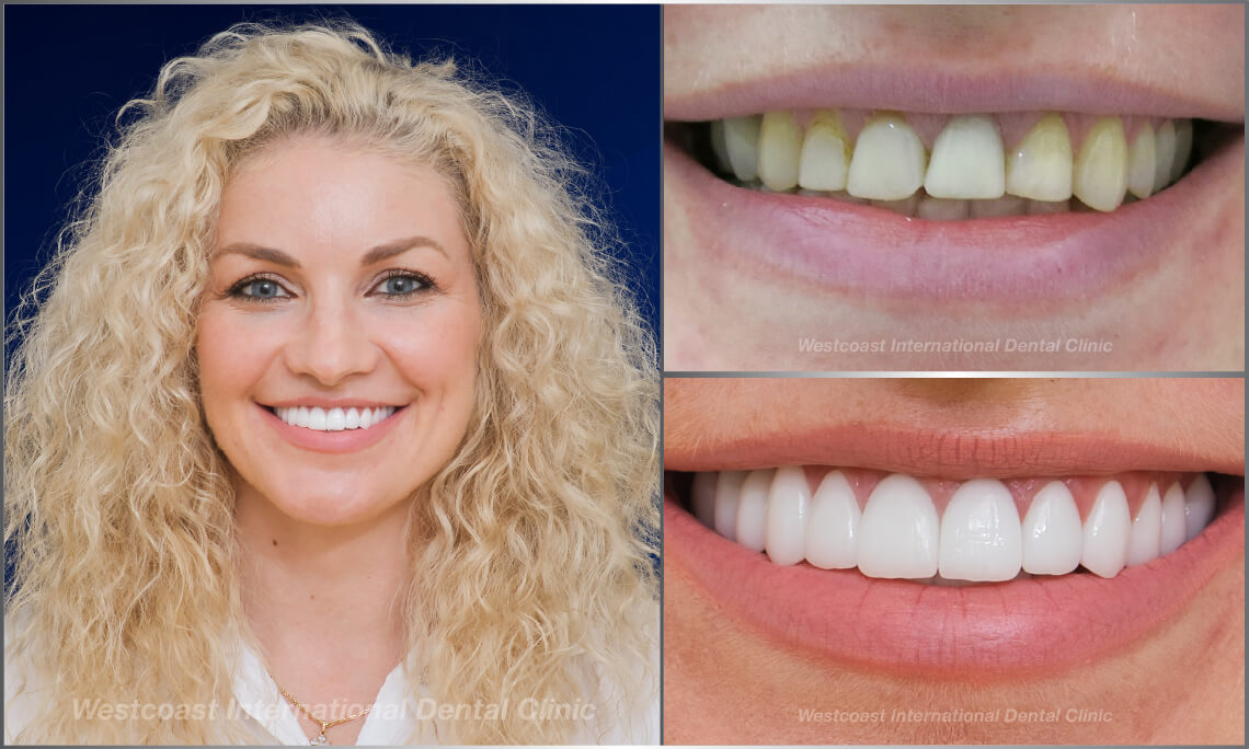 Westcoast Dental Clinic Smiles Gallery Westcoast Dental Clinic Smiles Gallery