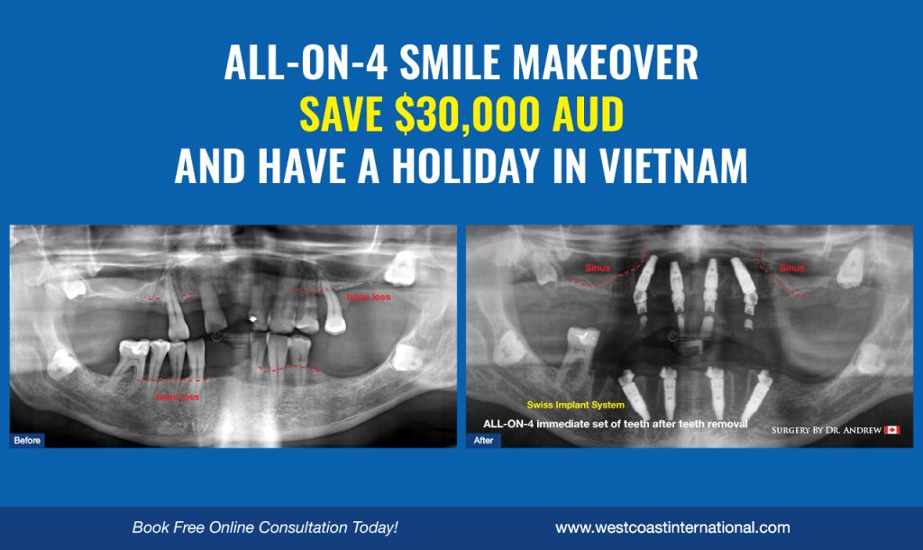 What Does All on 4 Cost in Vietnam