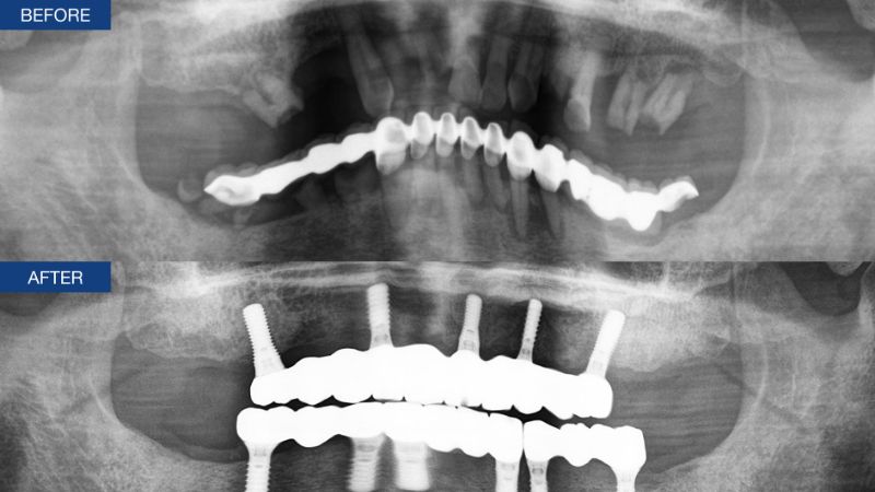 Panoramic radiographs before and after an individualised full-arch implant reconstruction