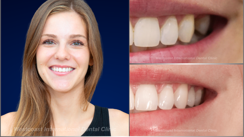 Julia’s smile before treatment and after the final restoration at Westcoast International Dental Clinic. Individual results vary.