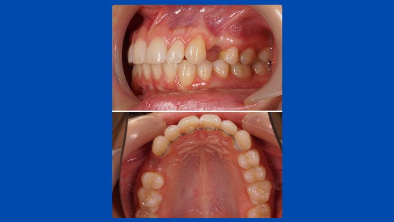 Pre-treatment intraoral views showing missing upper teeth and the ridge area requiring clinical assessment.