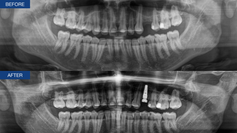 Panoramic radiographs taken before treatment and after implant placement in the upper-left posterior jaw.